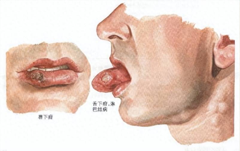 什么是花柳病?