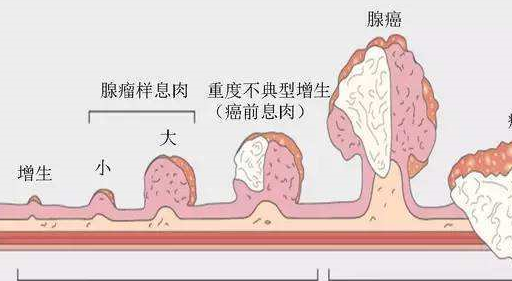 其实身体上多出来的这块"肉"或赘生出的"肉",叫做"息肉",是因为人体