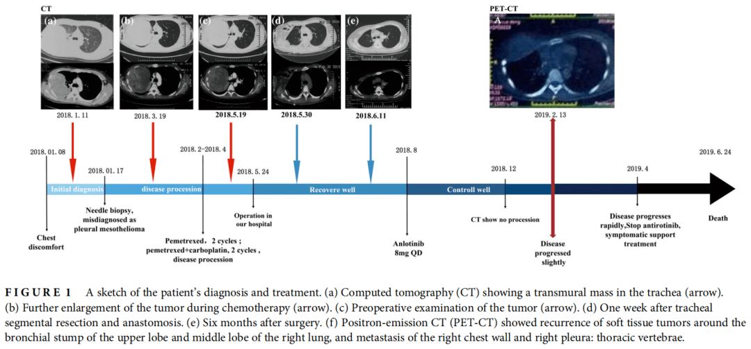 易被误诊,必要时需进行多基因检测辅助诊断,指导治疗_患者_肿瘤_细胞