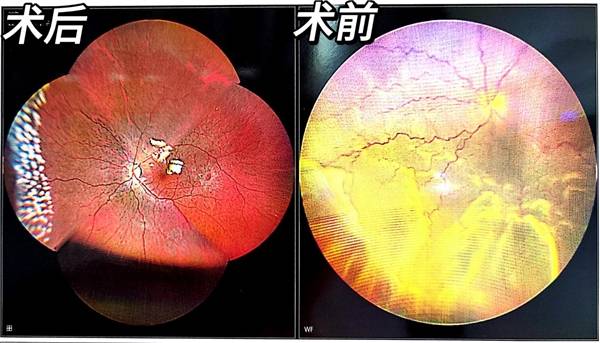 合肥瑶海普瑞眼科医院开展首例玻璃体切除手术治疗视网膜脱离