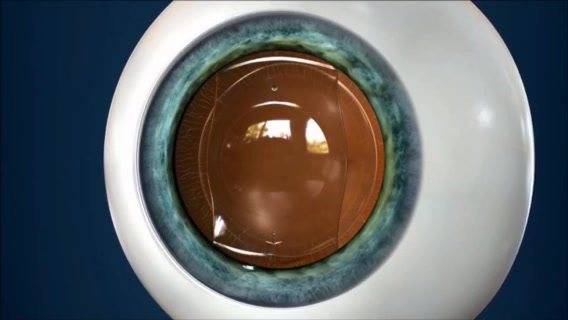 近视手术天花板——icl晶体植入术_视觉_患者_眼睛