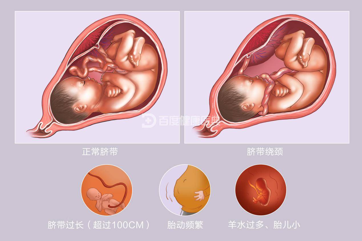 脐带受压图片