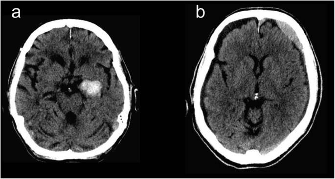 头部ct和mri报告中的神秘名词:脑梗死和脑白质病变?_医生_信号_患者