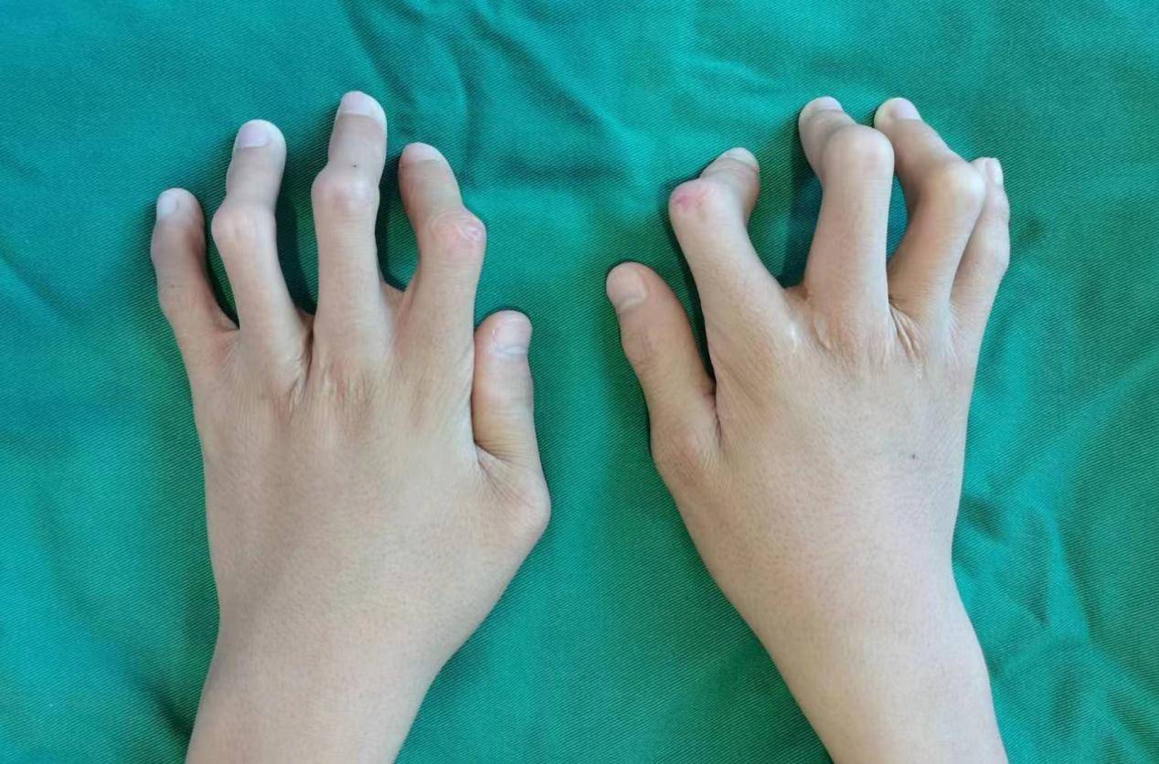 男孩手指天生畸形 瑞金市中医院"矫畸"手术解放双手