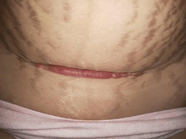 过来人经验分享,60天疤痕消失肚皮平坦!_凝胶_效果_按摩