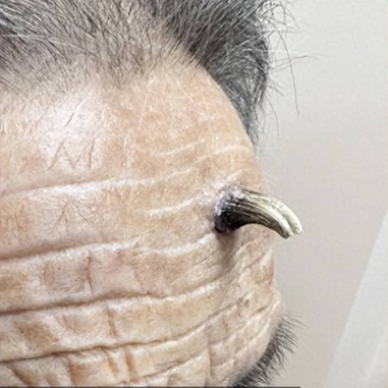 "诱发皮角的疾病大部分是良性皮肤病,如老年斑,寻常
