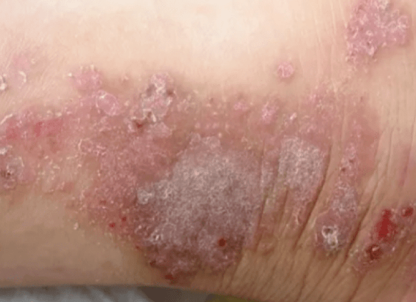 外阴湿疹是什么症状图片