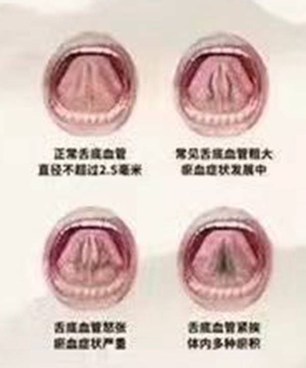 舌下取栓的功效与作用图片