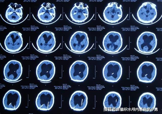 第4次出現頭痛且無法忍受,第2次到河北省保定市某三甲醫院,查頭顱ct