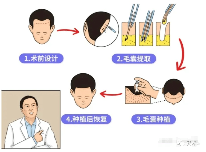 但是新种的头发往往在前期会脱~因为要稳定地从毛囊长出头发是需要皮