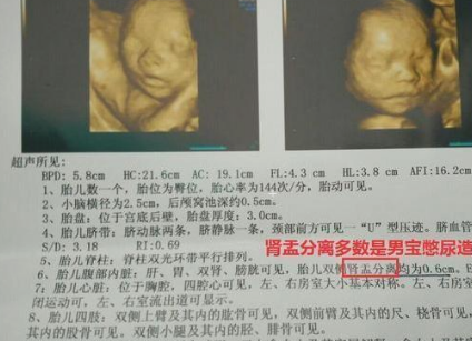 想要小棉袄的孕妈,b超单上经常出现这3种情况,美梦可能要成真了_宝宝