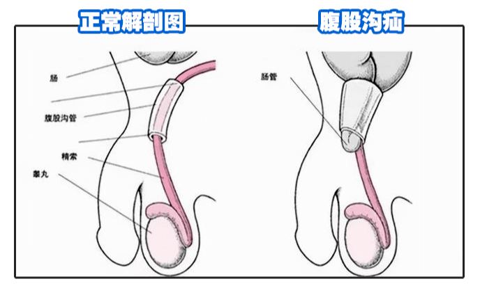 腹股沟疝的手术治疗及术后护理