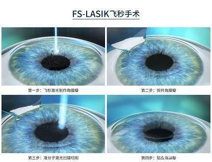 西安奕鸣眼科专家王从毅谈全飞秒手术和半飞秒手术相同和区别