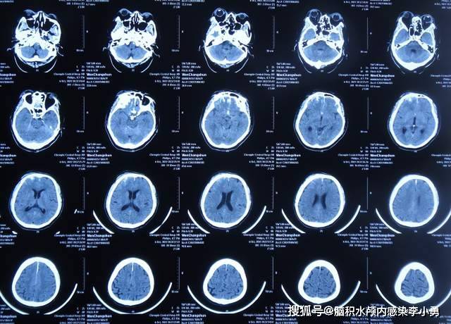 入院时呈嗜睡状态,检查头颅ct示右侧额部硬膜外血肿,双额,颞叶脑挫伤