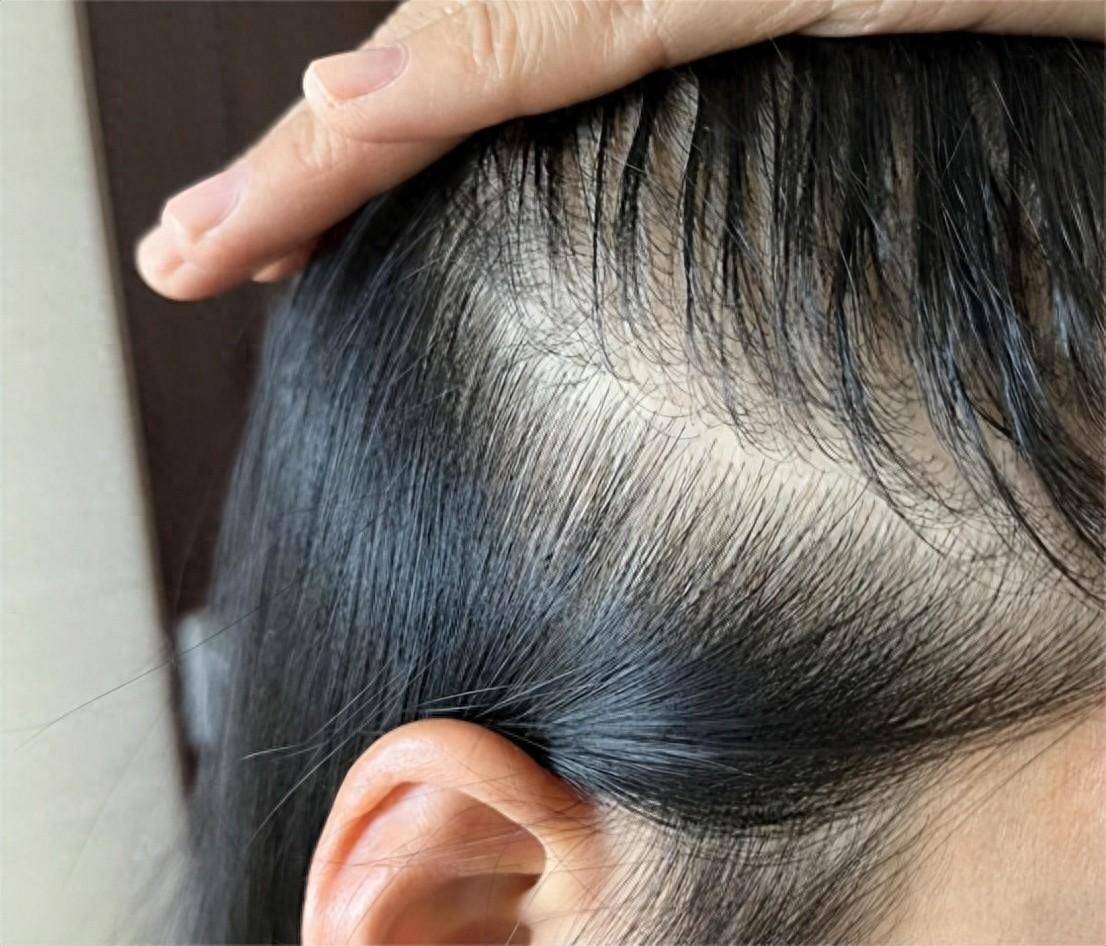 三年脂溢性脱发已成功上岸!实现秀发浓密的方法分享!