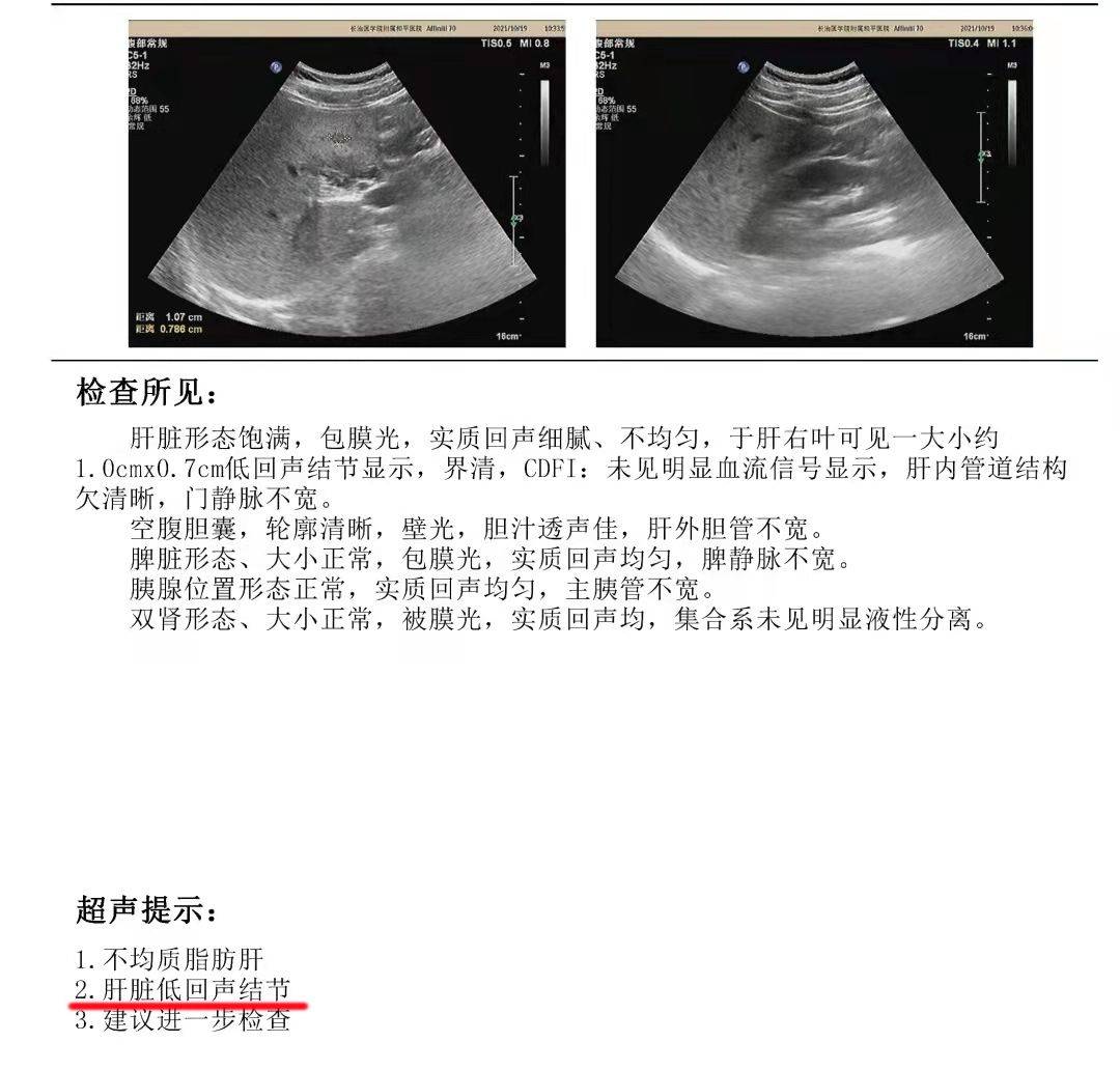 肝脏彩超上面这4点描述,肝硬化可能严重了