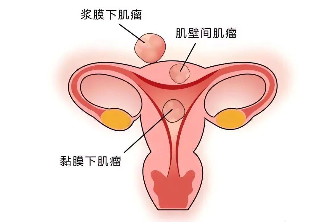 子宫肌瘤的预防与日常护理——保持健康的生活方式很重要