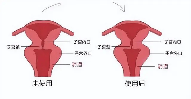 宫颈内口外口示意图图片