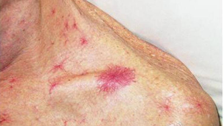 肝脏_皮肤_病变