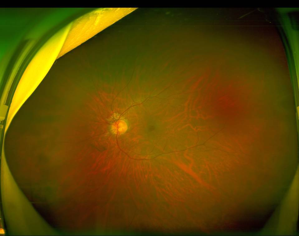 白内障,老花眼,眼底病解决有什么好办法吗!