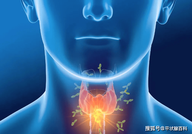 橋本甲狀腺炎早期可無典型臨床症狀,少數會出現甲狀腺毒症表現,進展時