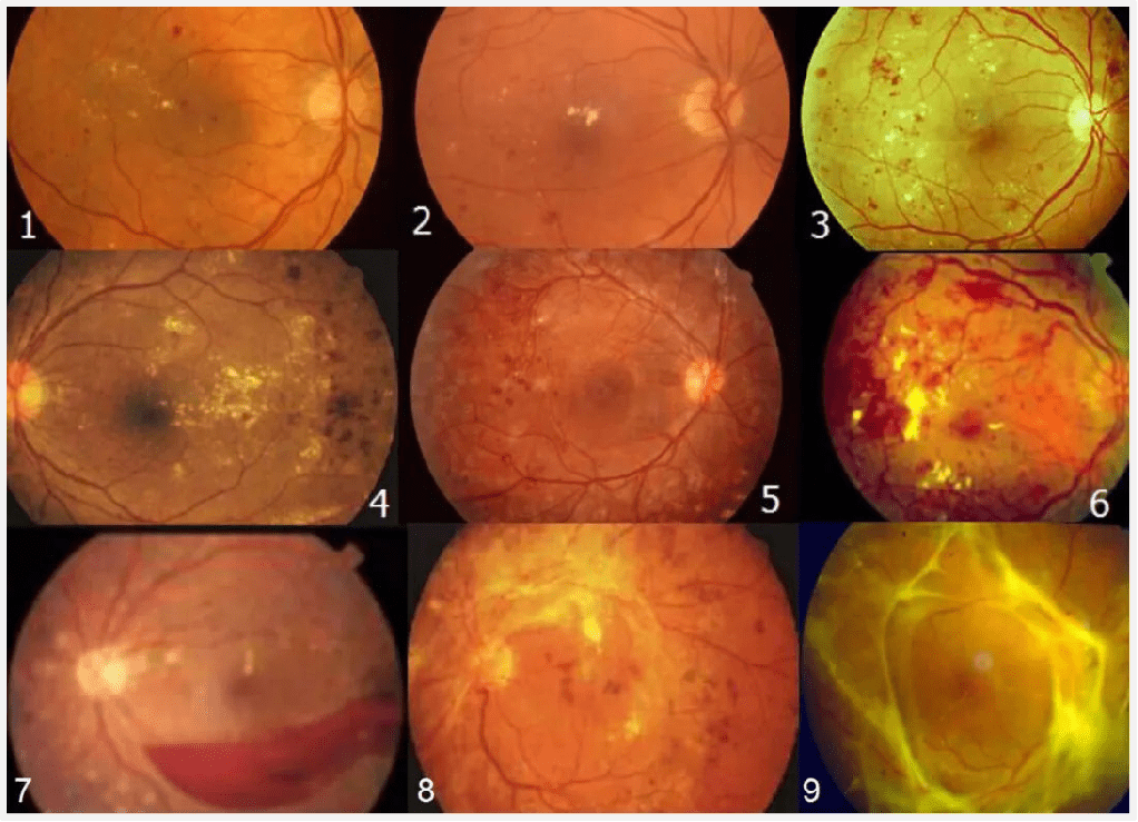 一张眼底照,可筛查出80%的眼病[1],还可以发现高血压,糖尿病,贫血等5