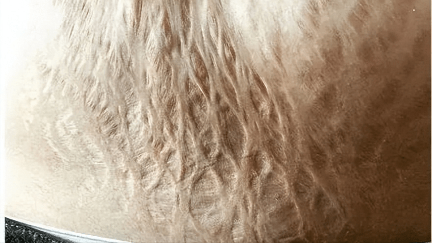 产后妊娠纹消除困难?每天坚持5分钟,"西瓜纹"悄悄变光滑!