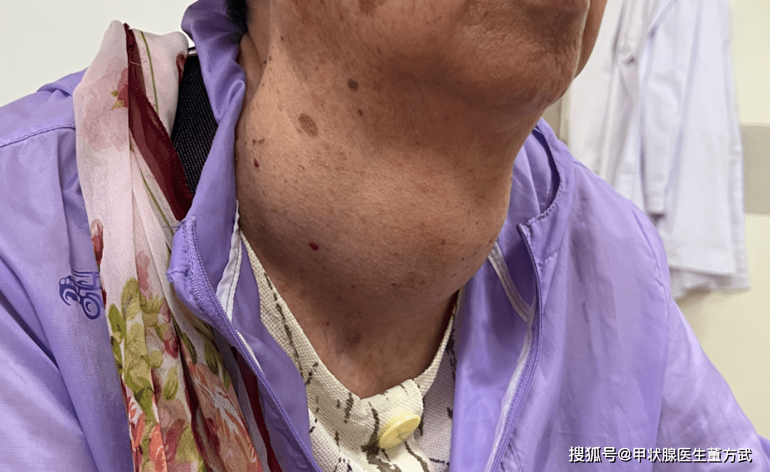 甲状腺肿大是甲亢还是甲减,如何区分?哪个危害更大?_影响_功能_患者