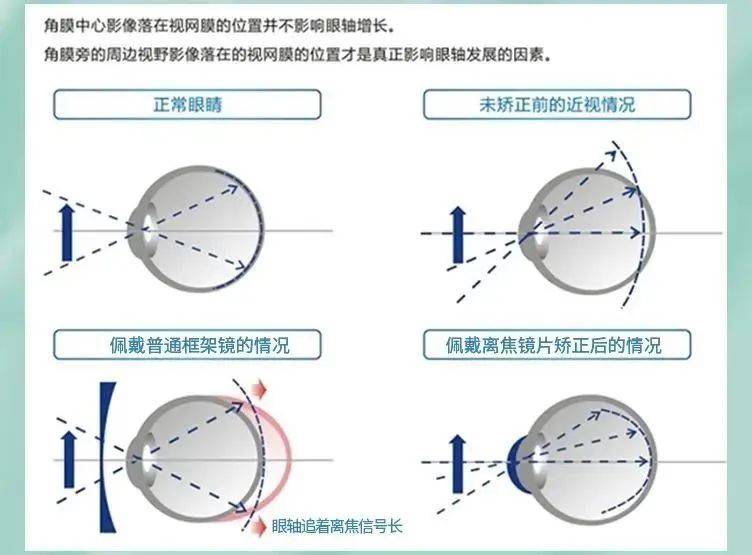 角膜塑形镜松紧配时图图片