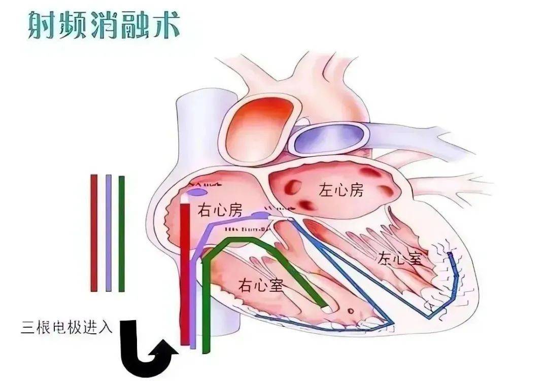 射频消融术原理示意图图片