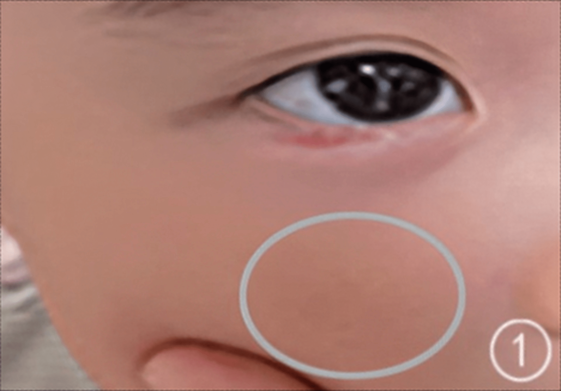 二,操作方法:清洁治疗区域面部皮肤后待干,患者取合适体位,充分显露