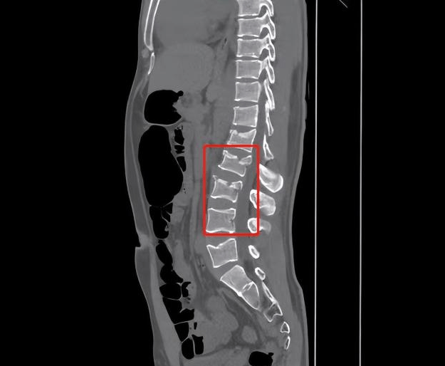 ct检查后显示腰椎椎体1
