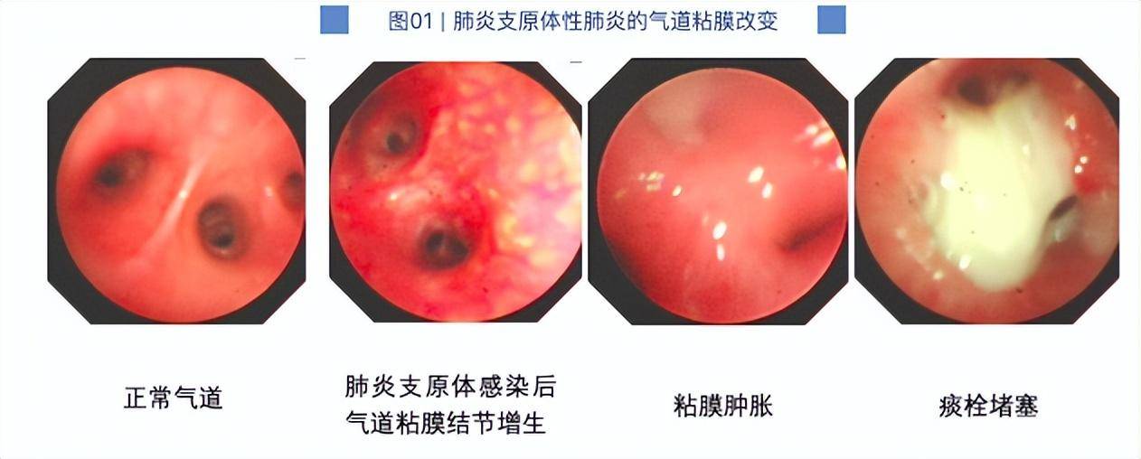 7岁男童肺部实变!有医院一天67例“洗肺”,医生紧急提醒