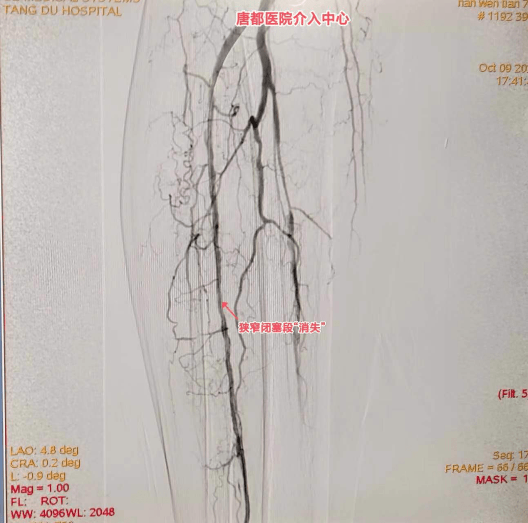 血壓控制不佳,雙下肢無力,發涼,行走活動後右側尤為明顯,右側膕動脈及