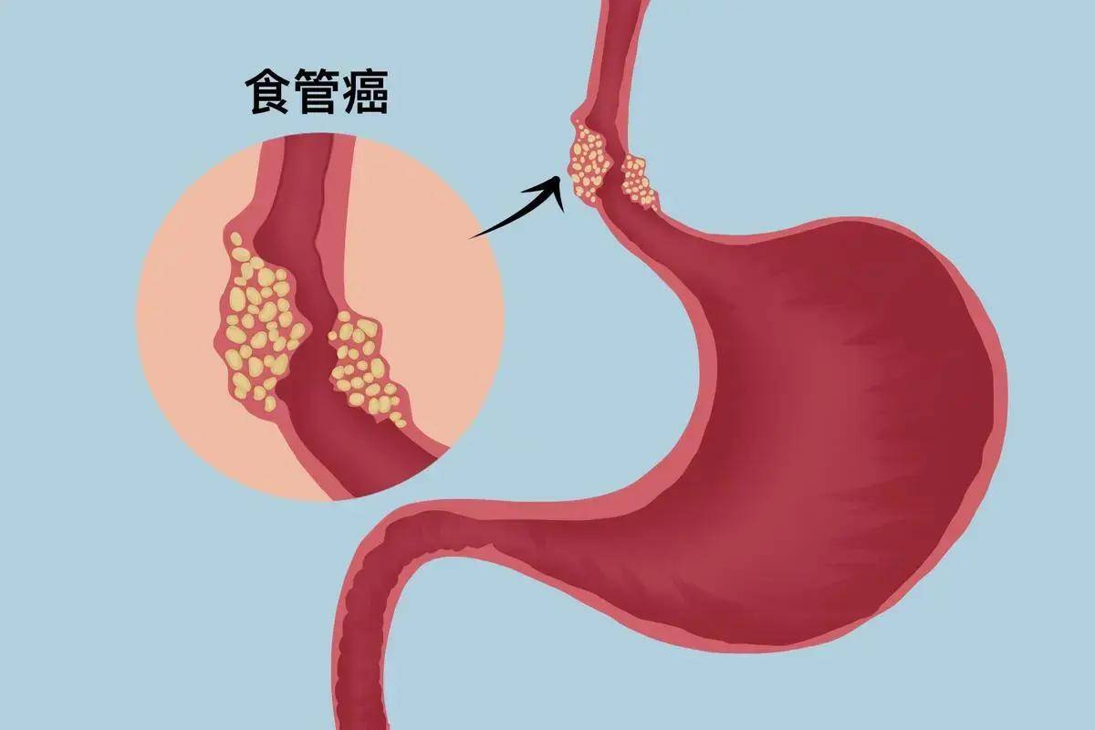 到底哪些原因引起的?早期如何篩查?_食物_因素_細胞