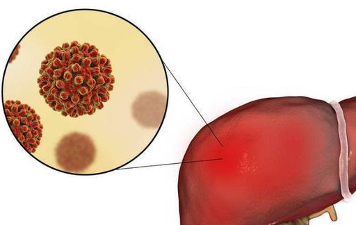 病毒性肝炎引發的肝硬化患者,其血液,體液中有可能含有數量不等,複製
