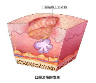 口腔潰瘍反覆發作怎麼治?_黏膜_影響_疾病