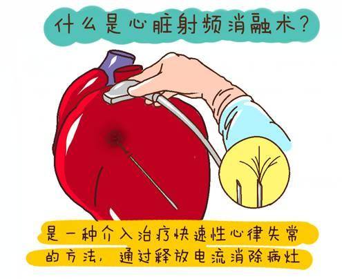 区人民医院成功开展室上性心动过速射频消融治疗_手机搜狐网