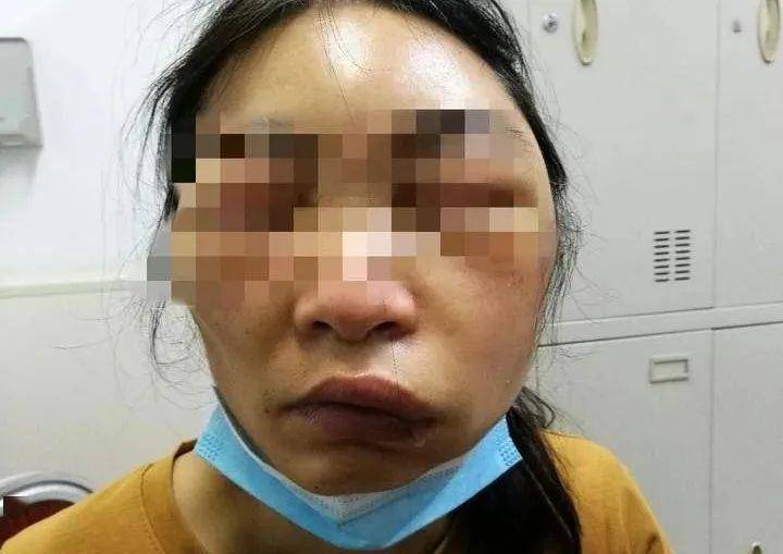 女子一觉醒来全脸暴肿,差点窒息!住低楼层的千万注意