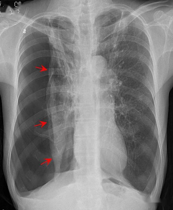 气胸时如何大体判断肺被压迫的程度