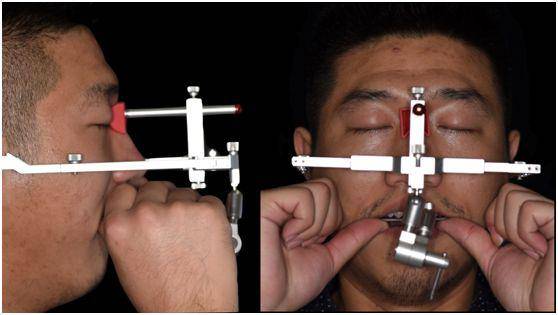 图31 面弓转移咬合关系