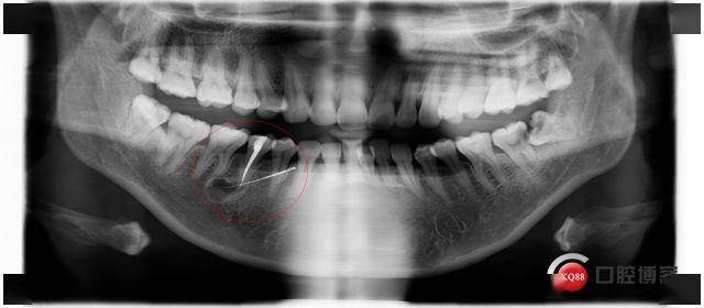 从微创到精准—后牙根尖囊肿摘除 根管倒充填手术