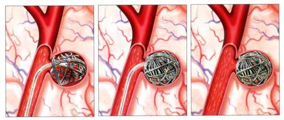 警惕颅内动脉瘤—脑子里的"不定时炸弹"