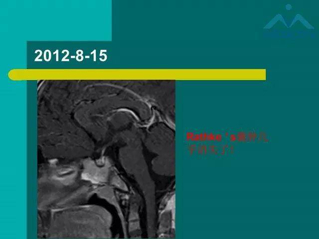 儿童rathke裂囊肿的影像与临床