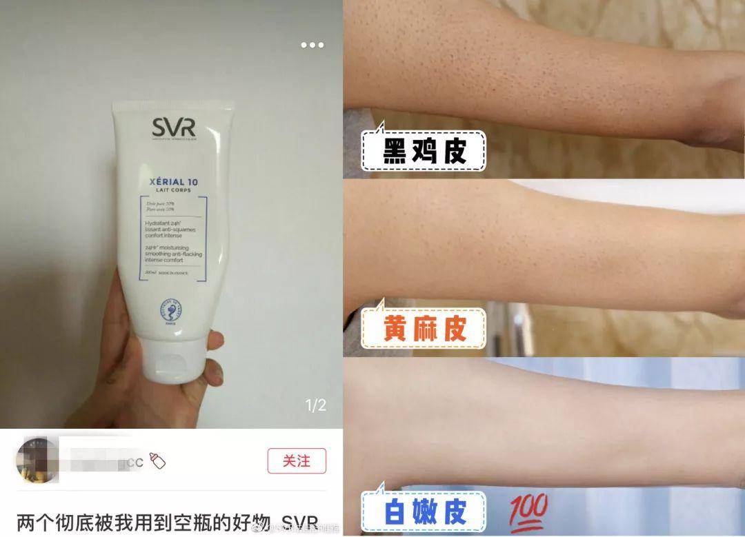 脱毛有鸡皮疙瘩(激光脱毛后起鸡皮疙瘩)
