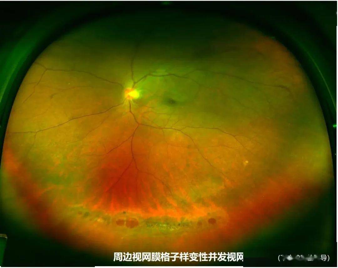 儿童有必要进行一次超广角的眼底成像检查,不仅是近视防控,还有很多