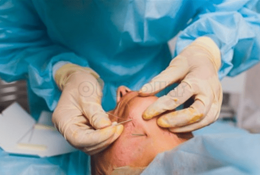 关于线雕费用的避坑指南深扒全脸线雕一般多少钱