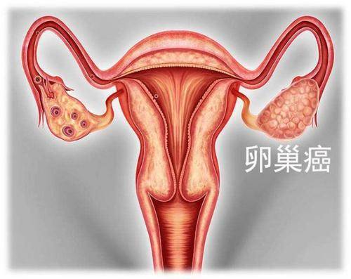卵巢癌的高危因素有哪些?宋莉医生讲这7种原因要引起重视