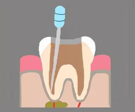 什麼是根管治療