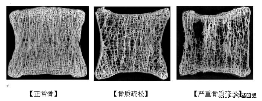 椎体骨小梁图片